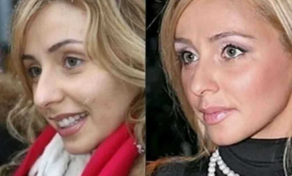 Татьяна Навка до и после ринопластики
