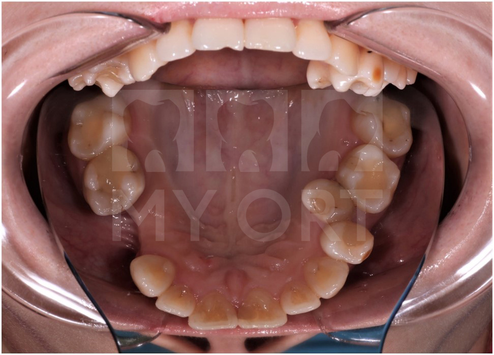 Верхняя челюсть ДО