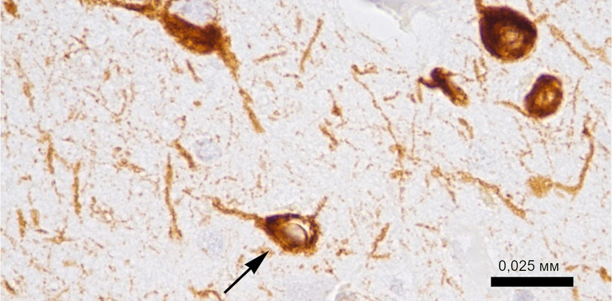 Нейроны (показано стрелкой) пациента, умершего от болезни Альцгеймера. Тау-белок окрашен с помощью иммуногистохимических препаратов в коричневый цвет. © CC BY-SA 4.0/Tulemo