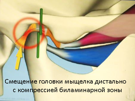 Последствия для ВНЧС смещения головки сустава кзади (дистально).