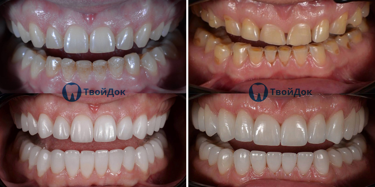 Установка виниров | ТвойДок 