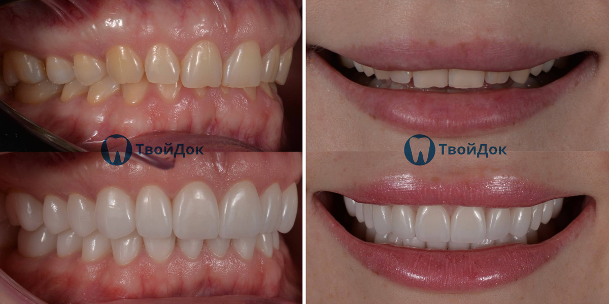 Установка виниров | ТвойДок 