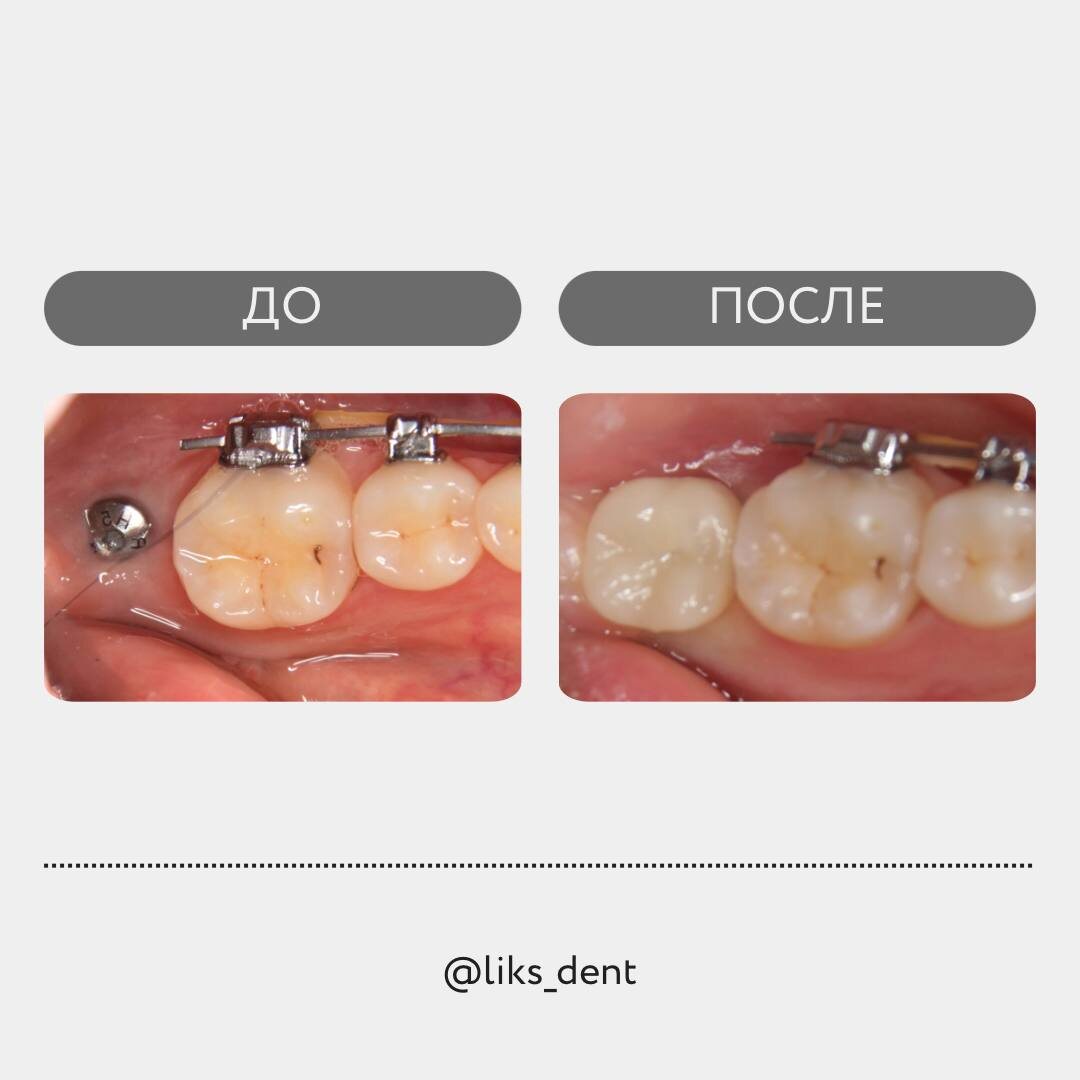 До/после временная коронка на имплант 🔥
