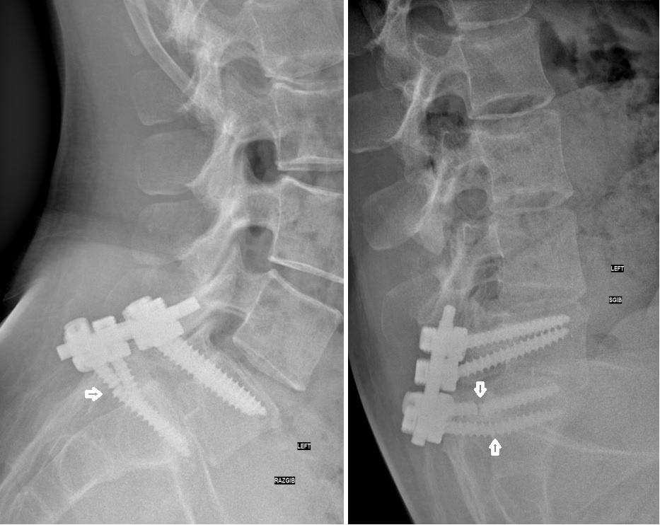 Это снимок не данного пациента, но так же с неудачей- перелом винтов.