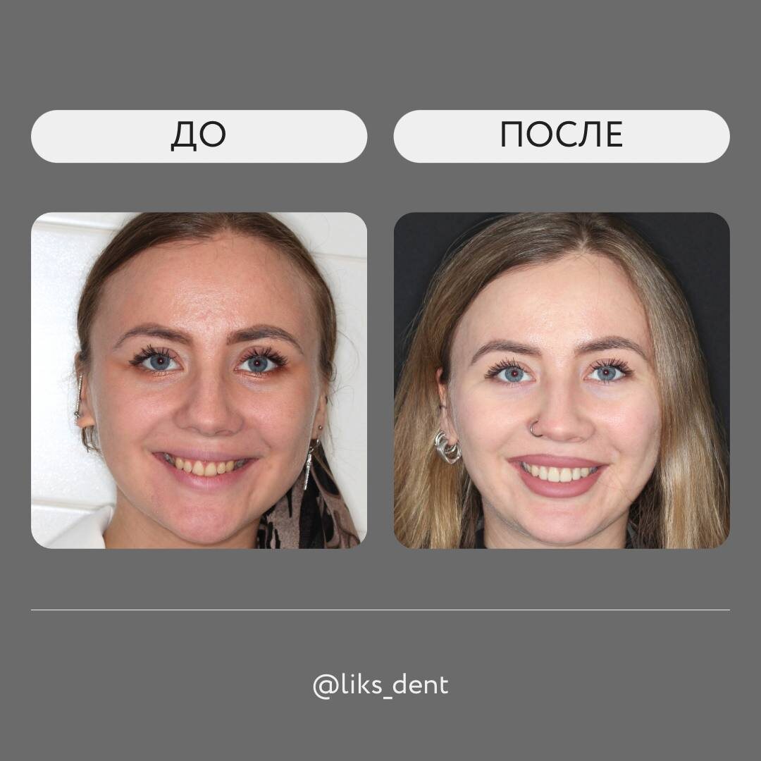 Преображение лица с помощью виниров: улыбка, которая меняет всё!