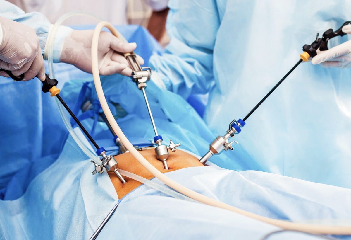 Операция по удалению аппендицита, лапароскопия 