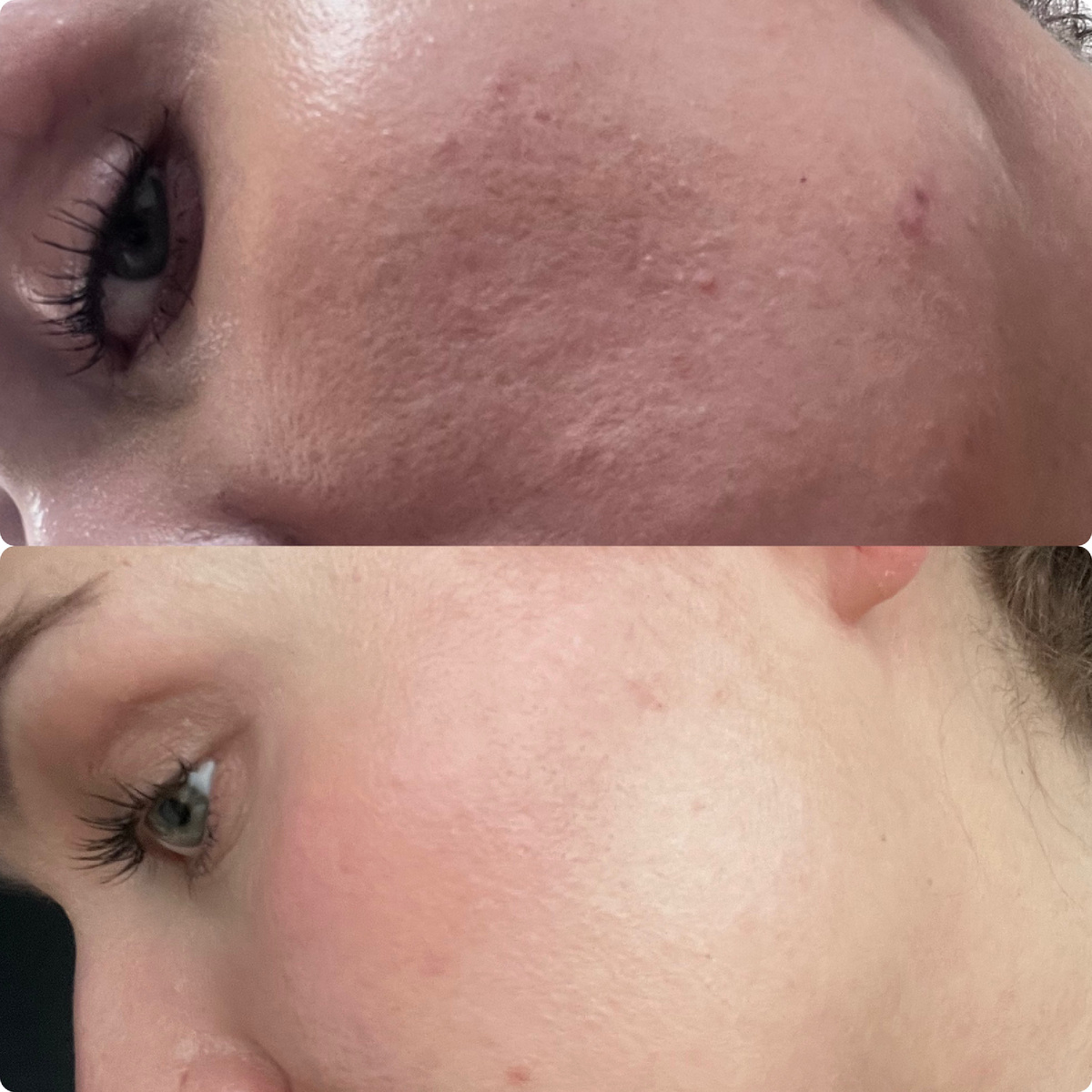 Верхнее фото- 19.08, на адапалене; нижнее фото- на ретиноле 09.12