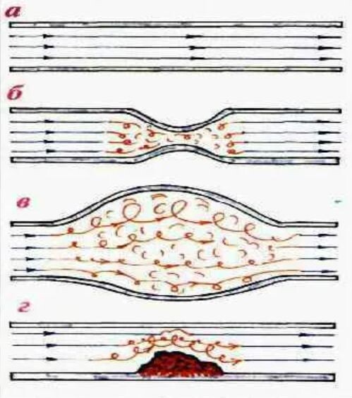 А—ламирное течение крови. Норма. Б, В, Г —стеноз, аневризма и тромб соответственно. Турбулентные потоки.