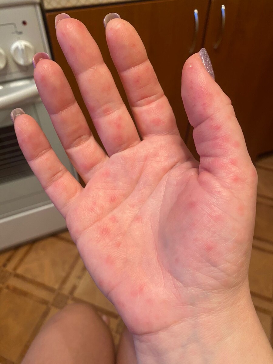 От вируса Коксаки на теле появляется высыпания. Руки отекли и зудят.