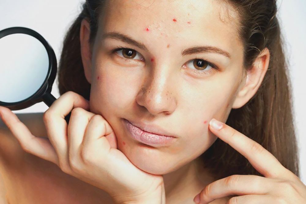 Акне на лице