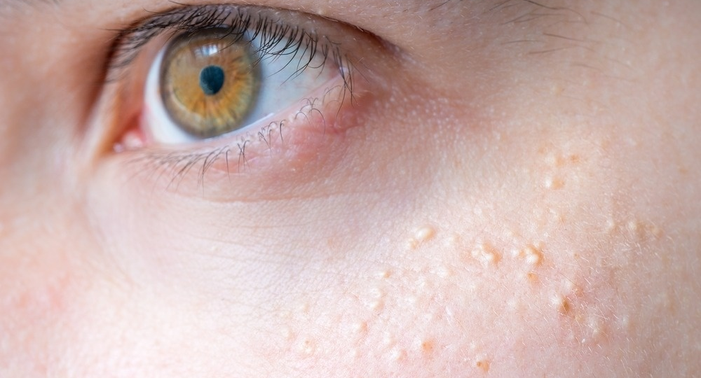 ✨ Все про милиумы: что это, как убрать и как предотвратить их появление ✨