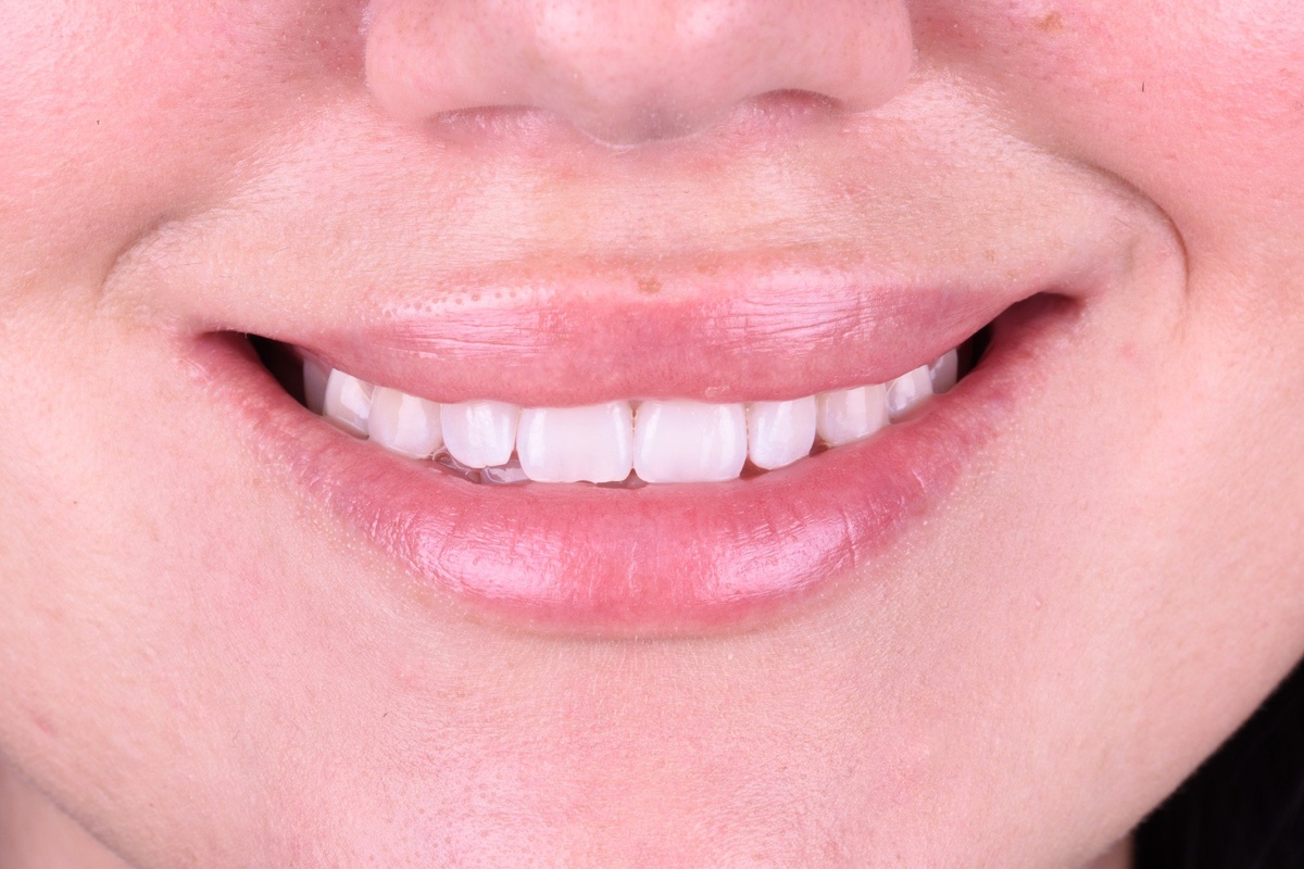 У белоснежной улыбки своя магия: она приковывает взгляды и повышает уверенность в себе.