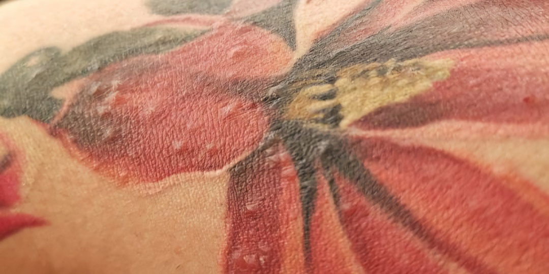 Аллергия на татуировку