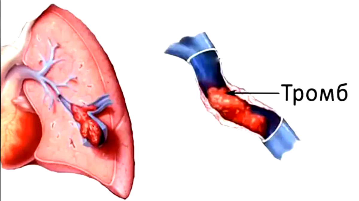 Тромб перекрыл просвет сосуда