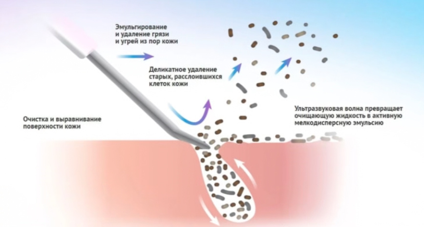 Принцип работы УЗ-аппарата для чистки лица