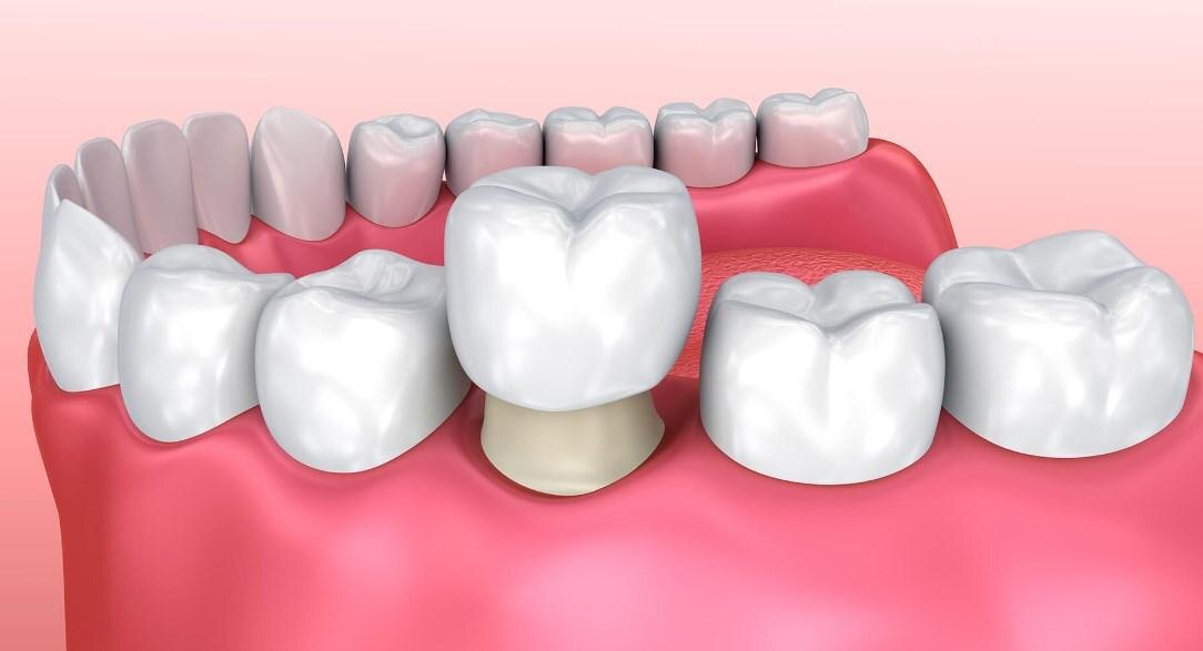Зубные коронки