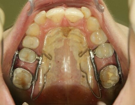 Дистализация (смещение назад) верхних моляров.