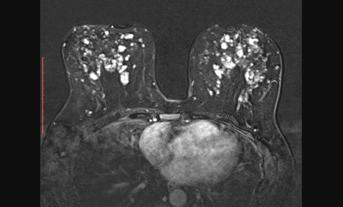 Многочисленные кисты обеих молочных желез.