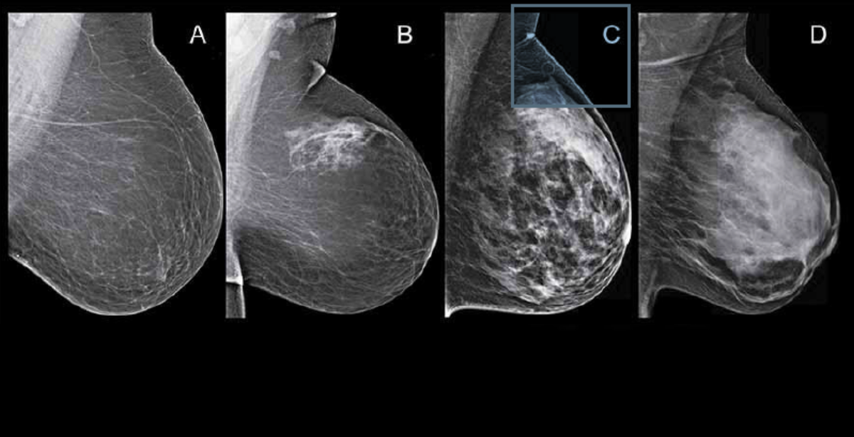 Как отличить фиброзно-кистозную мастопатию от рака молочной железы ...