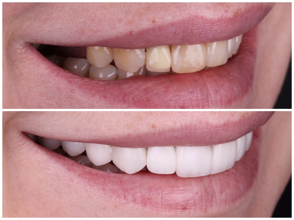 Восстановление эстетики улыбки под руководством Лукъяненко Артура Викторовича, всегда прекрасный результат. 