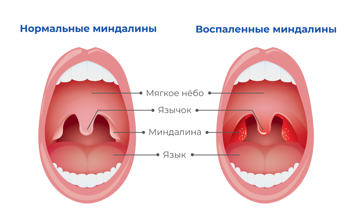 Рисунок – Небные миндалины (слева – без налетов, справа – с налетом: стрептококковый тонзиллит)