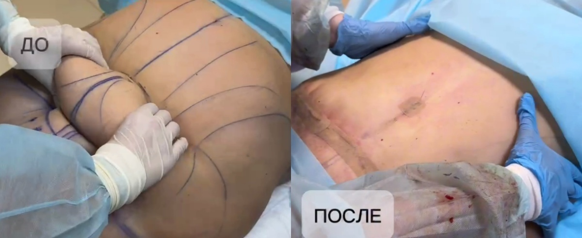 Абдоминопластика и липосакция фото до и после. Фото с сайта хирурга Д.Р. Гришкяна. Имеются противопоказания, требуется консультация специалиста