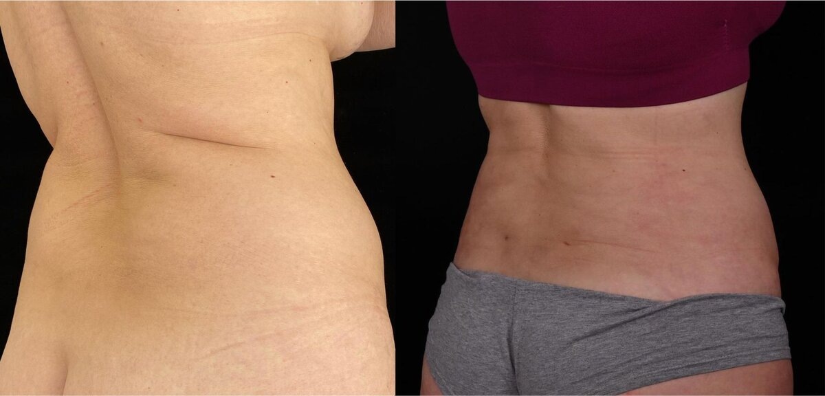 Почти 2 месяца после абдоминопластики и липосакции спины, боков. Ещё присутствуют отечность, которая в скором времени сойдёт. Фото до и после. Фото с сайта хирурга Д.Р. Гришкяна. Имеются противопоказания, требуется консультация специалиста