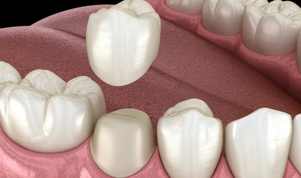 Изображение с ресурса ionika-dent.ru