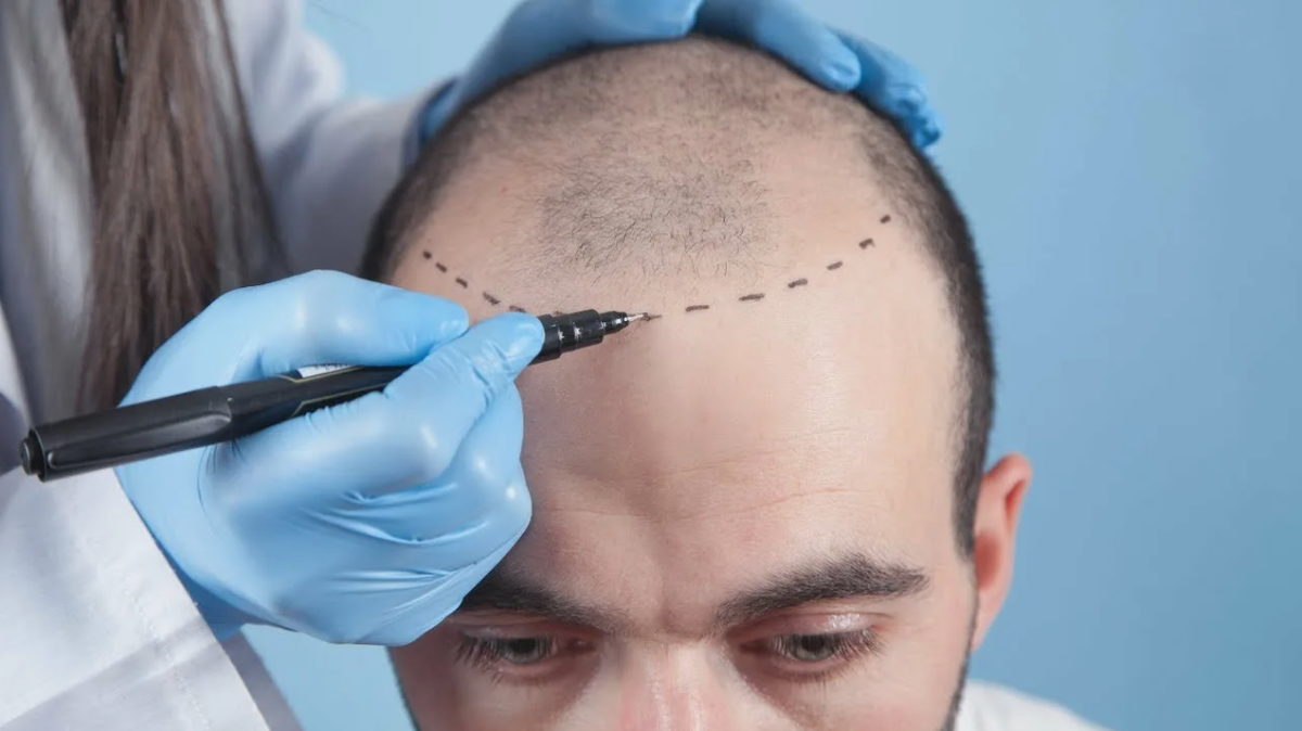 Пересадка волос: первичная консультация и подготовка к процедуре 