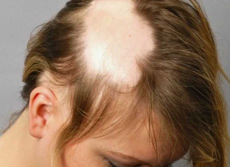 Очаговая алопеция у женщин: причины, профилактика и лечение