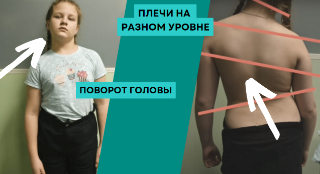 Посмотрите на вашего ребенка, как он стоит, и сразу увидите, есть ли отклонеия от нормы