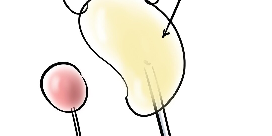 А что происходит с ногами у диабетиков, почему их ампутируют, и как этого избежать?