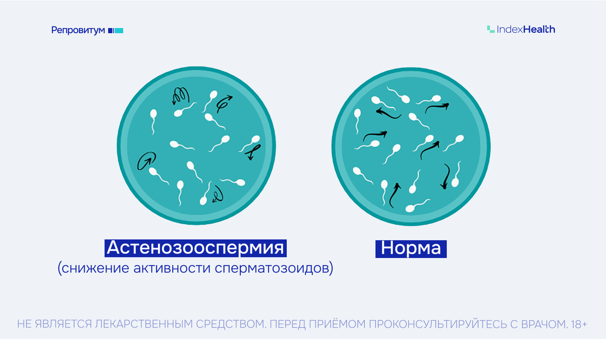 Астенозооспермия: снижение активности сперматозоидов