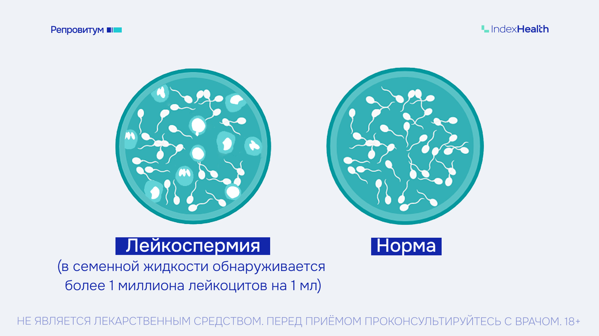 Лейкоспермия