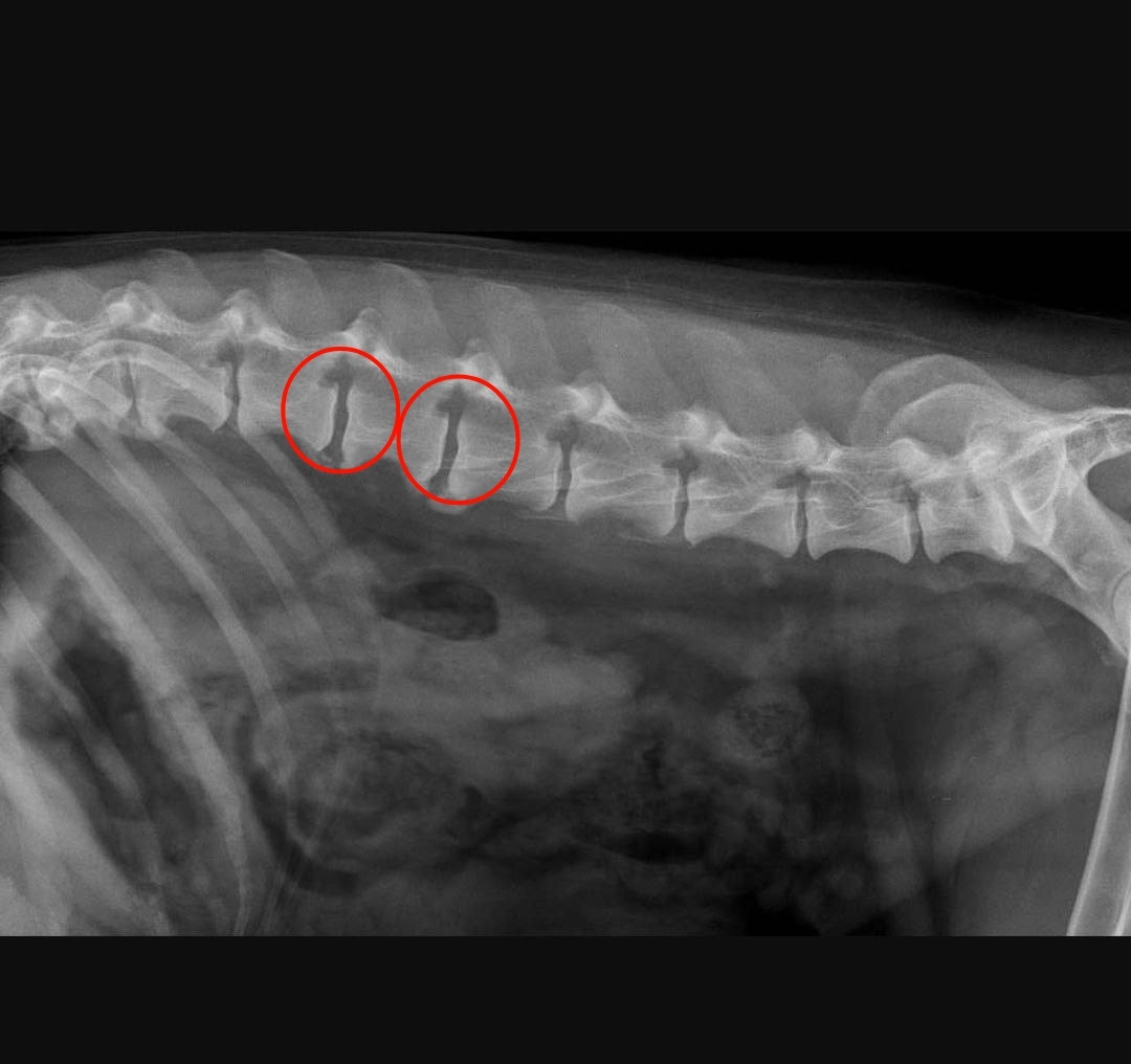 Спондилез позвонков