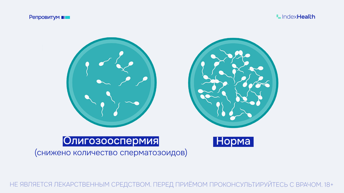 Олигозооспермия