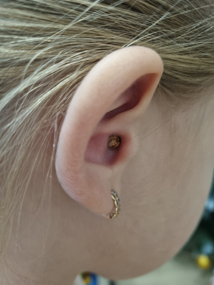 "Желудь" в ухе