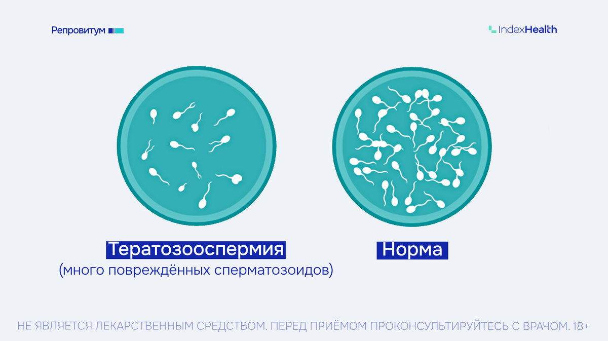 Тератозооспермия: много поврежденных сперматозоидов