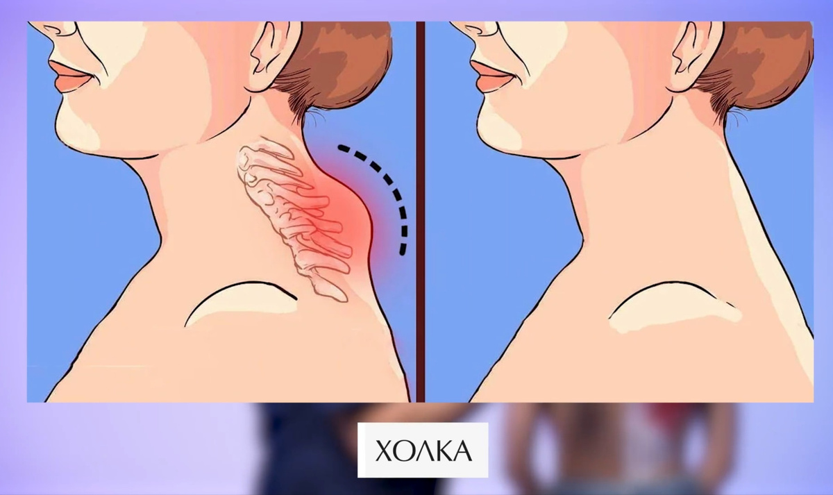 Холка – бедствие современной цивилизации