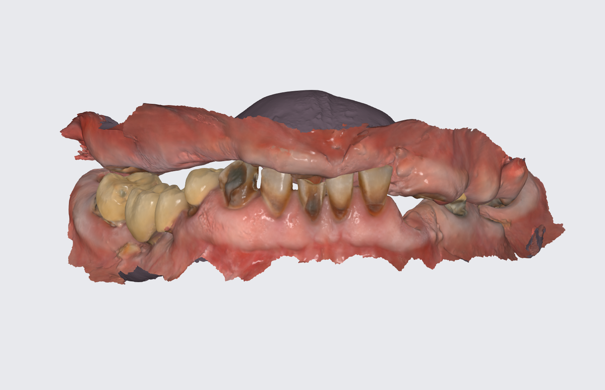 Цифровой слепок челюстей