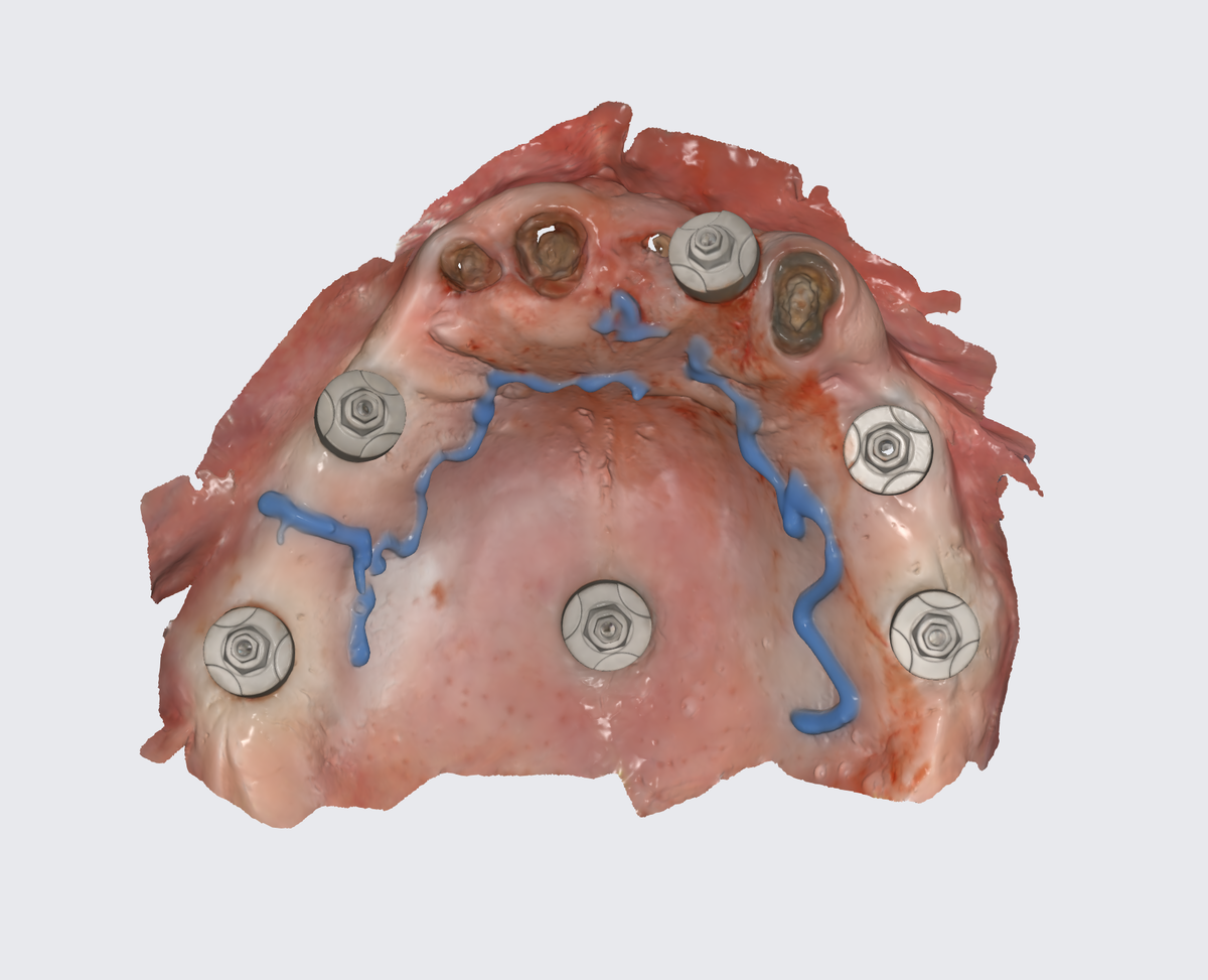 Рентгеноконтрастные маячки в верхней челюсти пациента