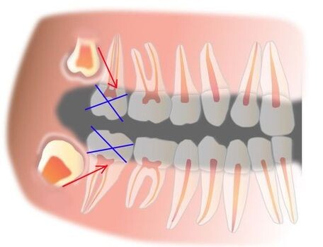 Схема "замены" (в перспективе) вторых моляров ("семёрок") на третьи ("восьмёрки").
