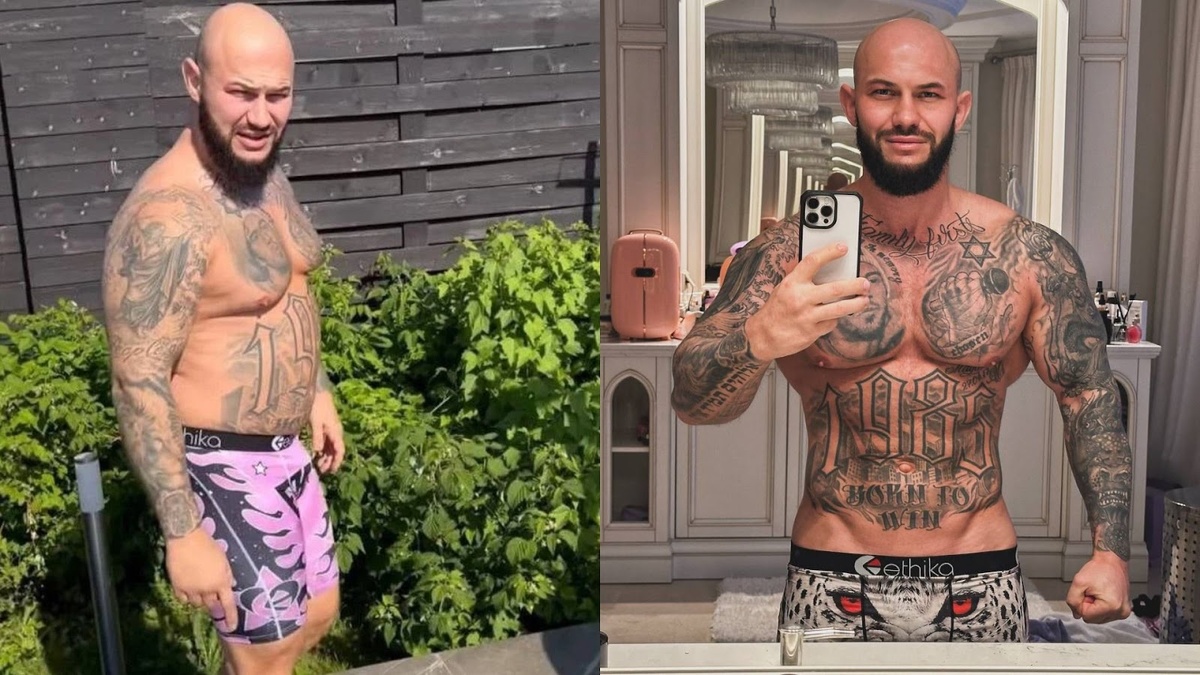 Джиган до и после пластической операции