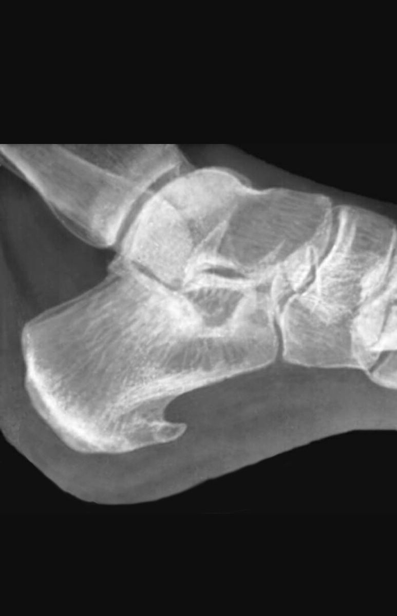 По ощущениям,у меня уже как то так,при чем шип растет вниз...