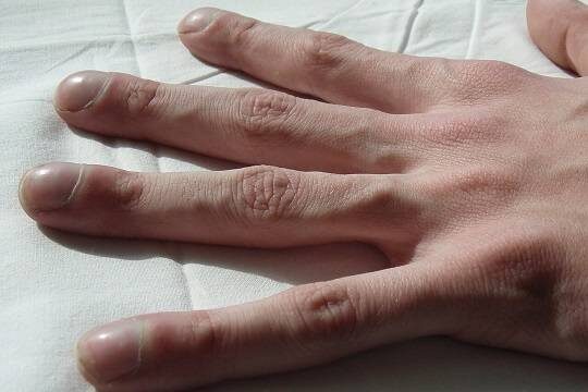    Пациенты с муковисцидозом пожаловались на препарат-дженерик