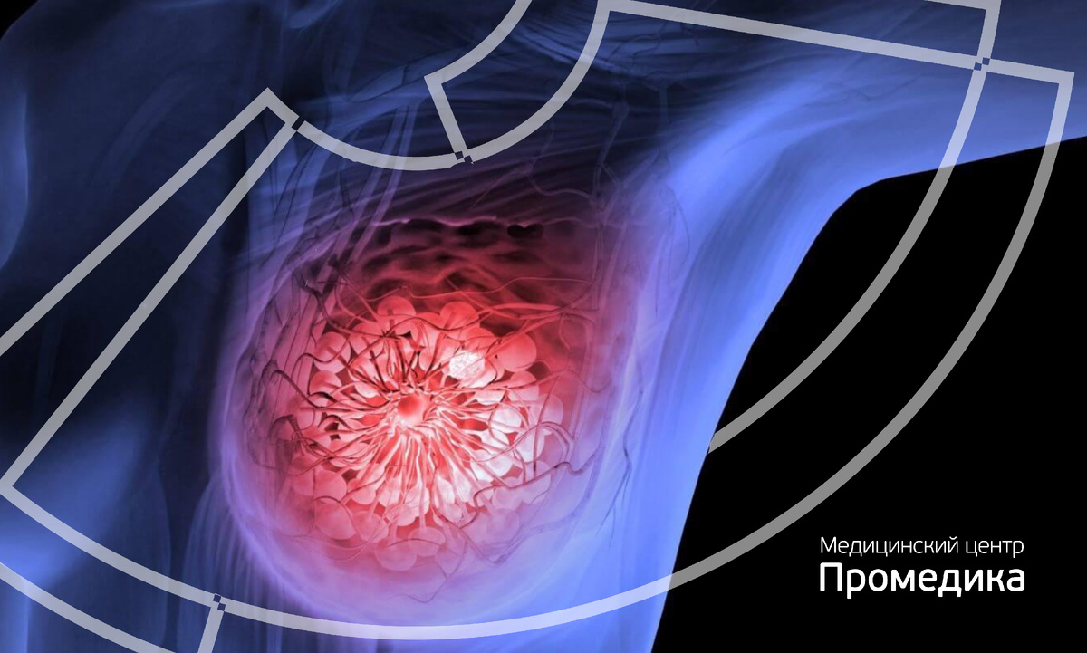 Фиброзно-кистозная мастопатия: болезнь или не болезнь? 