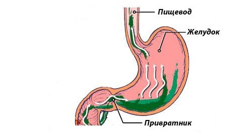 Излечиться от заброса жёлчи без волшебной таблетки