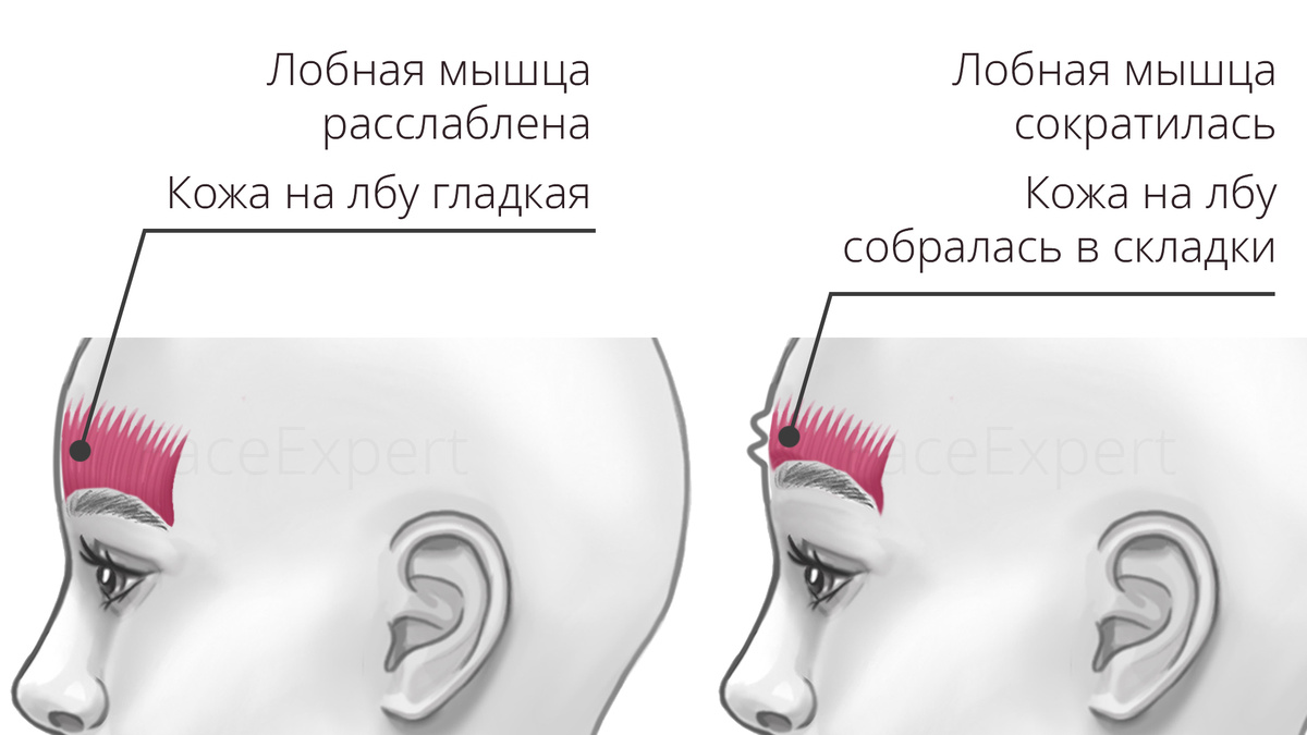 Горизонтальные морщины на лбу образуются из-за перенапряжения лобной мышцы