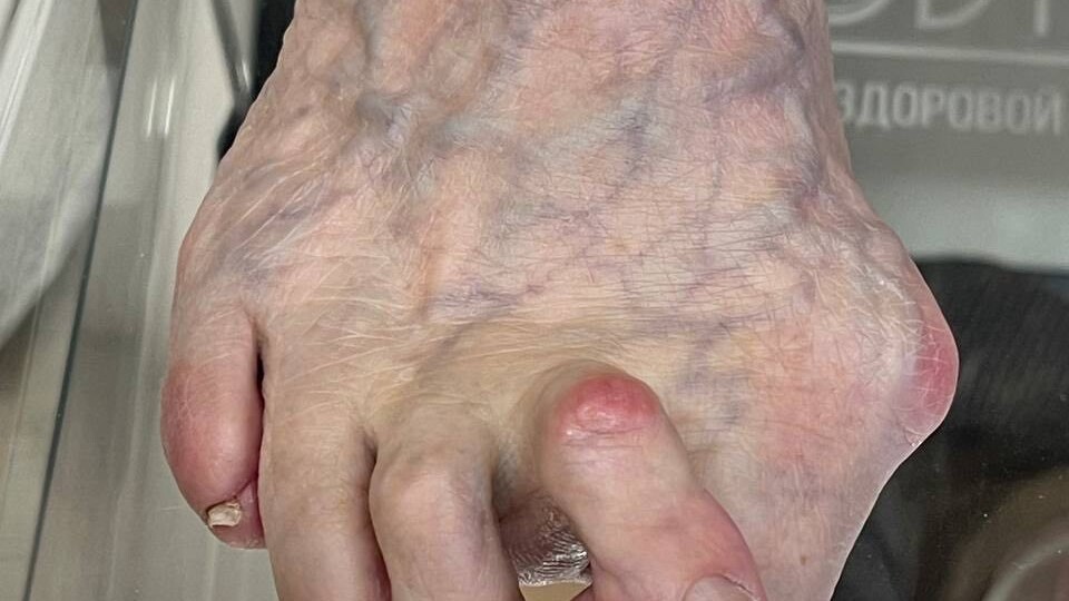 Мозоли на пальцах стопы: эффективный метод