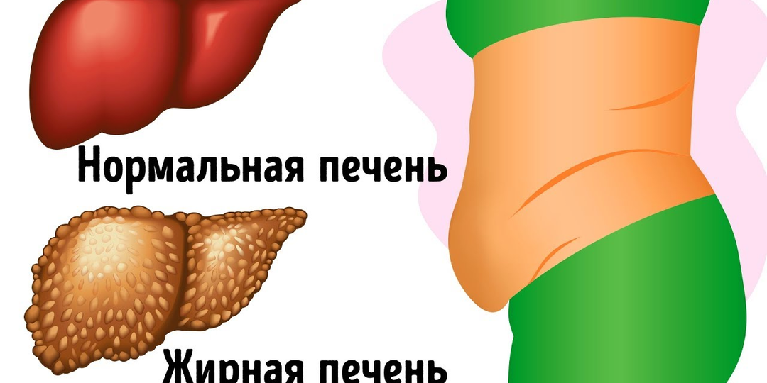 Диабет и ПРОБЛЕМА-жир возле талии. Это признак гепатоза.